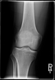 Tibial Plateau Fracture Lawyer